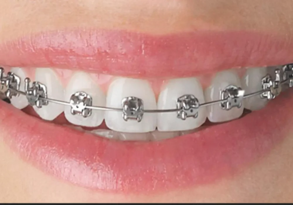 Braces Treatment
