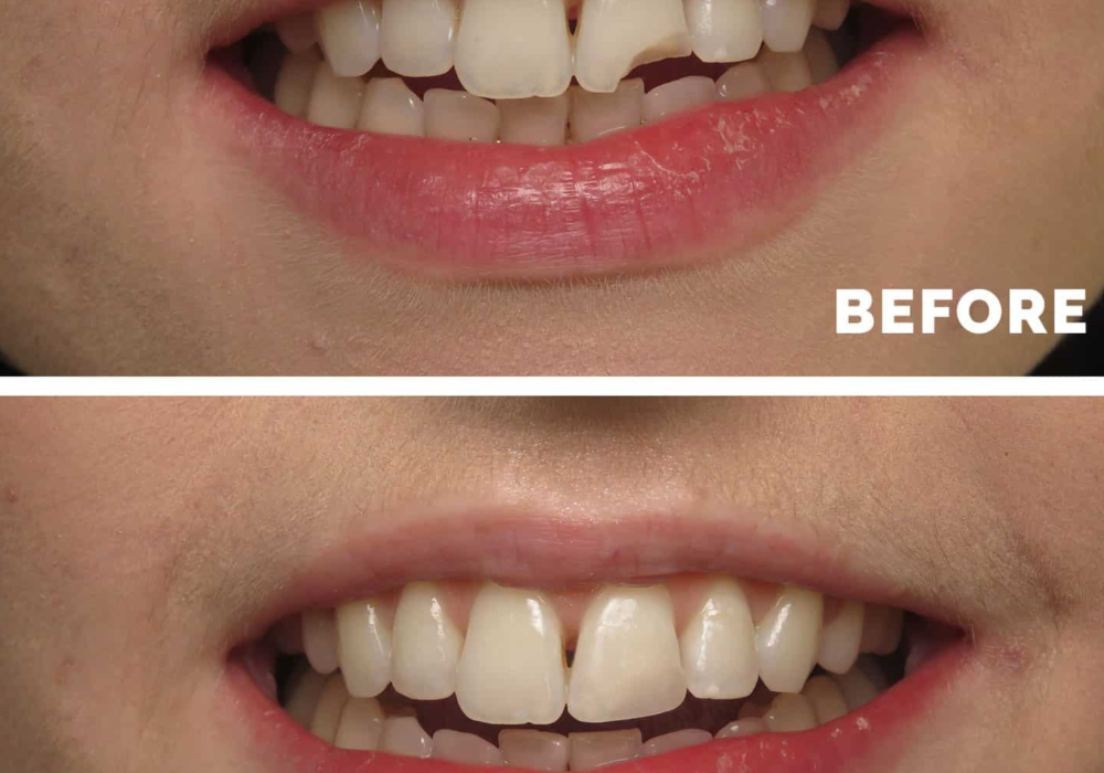 Composite Bonding