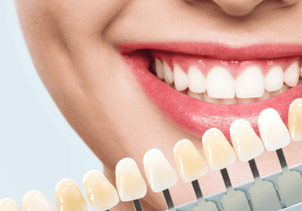 Dantveda Porcelain Veneers