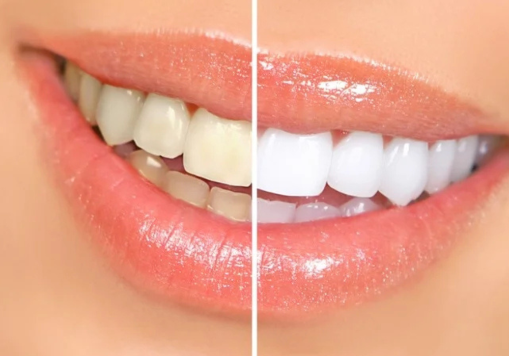 _Dantveda Teeth Whitening _