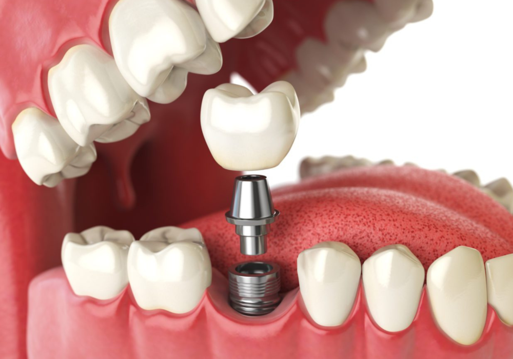 Dental Implants