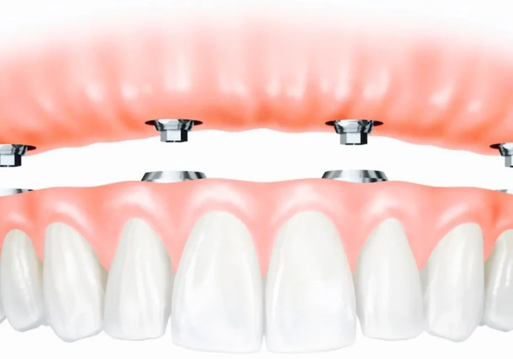 Fixed Dentures
