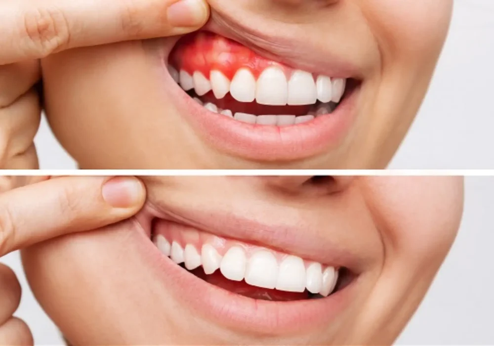 GUM Treatment