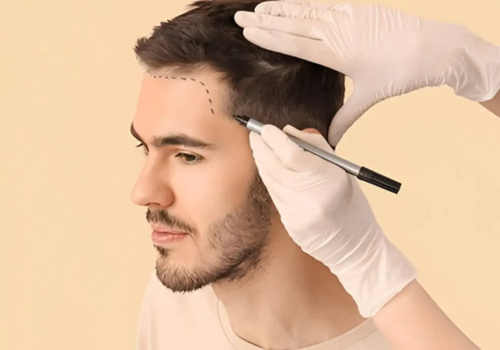 Hair Transplant