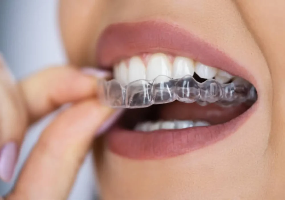 INVISALIGN