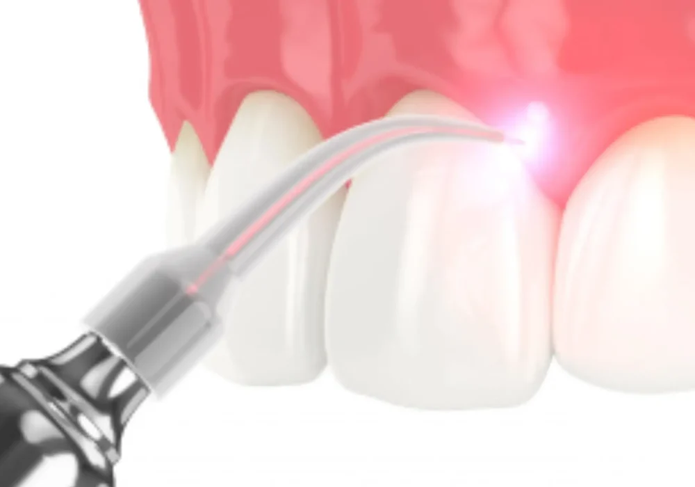 Laser Therapy