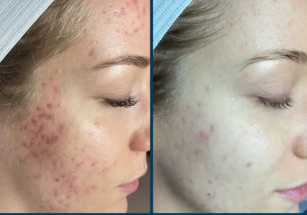 Microneedling