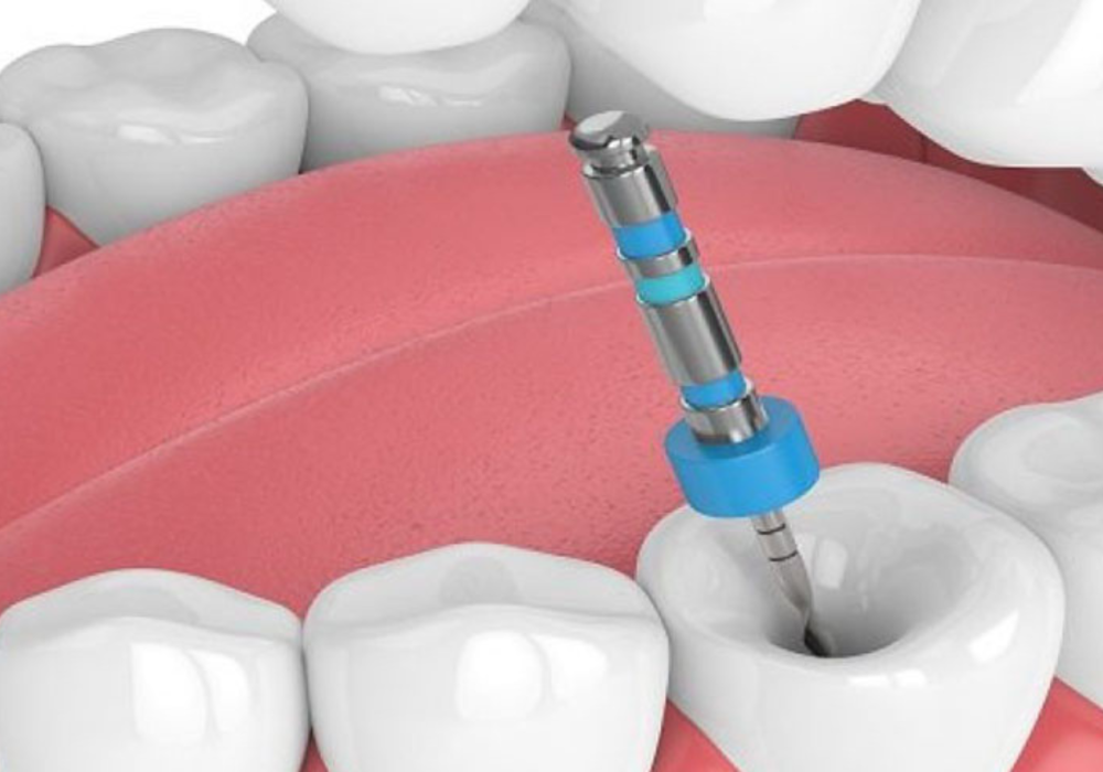 dantvedaPainless Root Canals